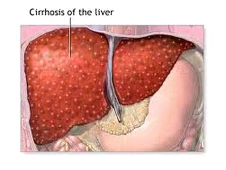 درباره سیروز کبدی بیشتر بدانید