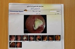 خارج کردن باند استریل پس از 10 سال از بدن بیمار/10 سال زندگی پُرمشقت بر اثر اشتباه پزشکی